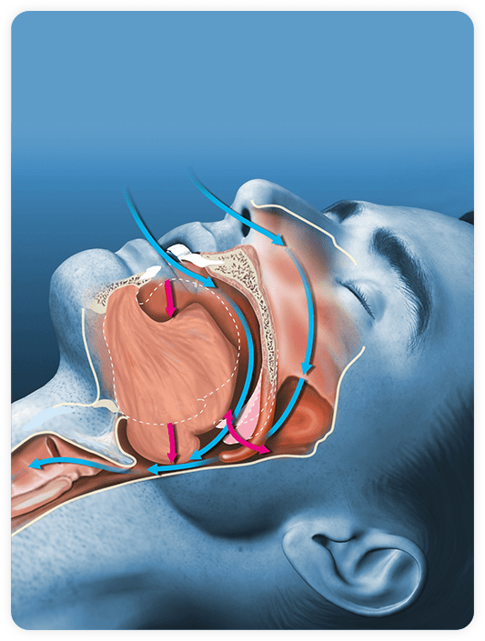 La apnea obstructiva del sueño - Clínica Birbe